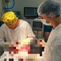 Хирурги восстановили череп ребенка, разрушенный в результате ДТП